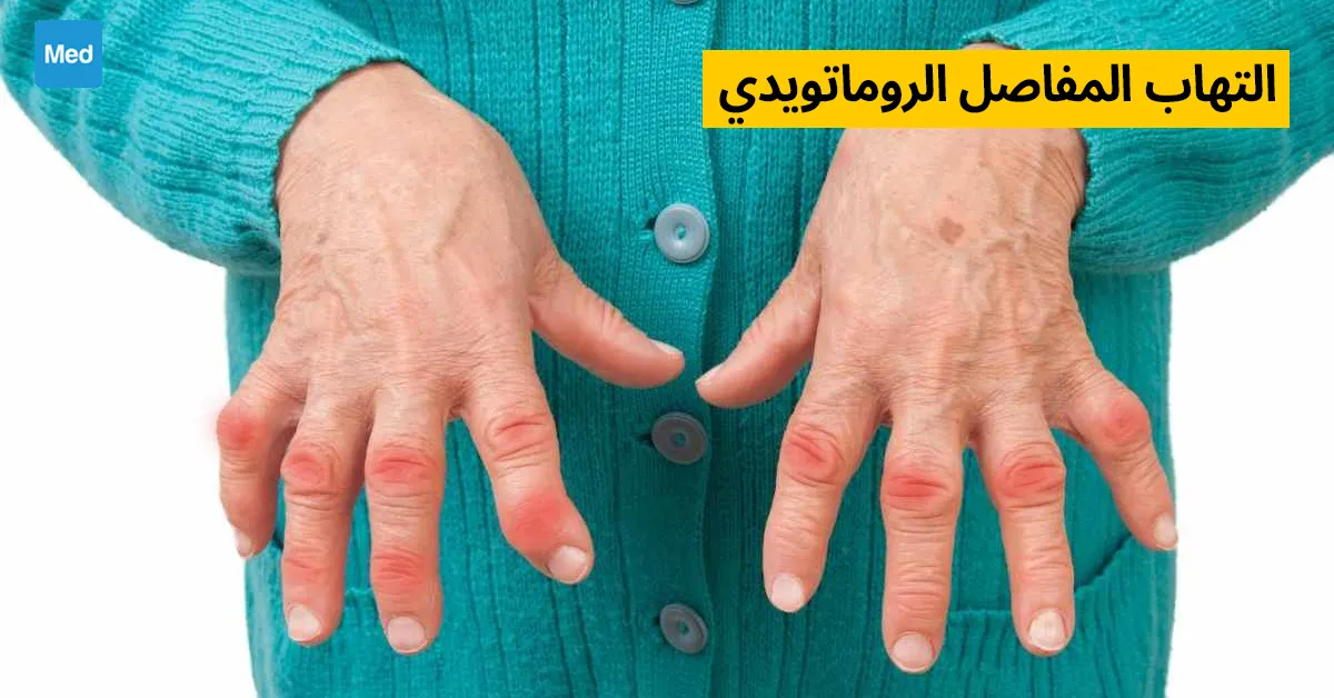 التهاب المفاصل الروماتويدي